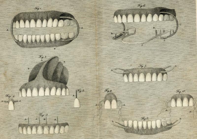 Invention of the mineral paste, a precursor of modern porcelain used for esthetic crowns